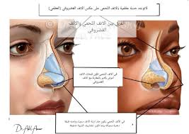 تجميل الانف اللجمي